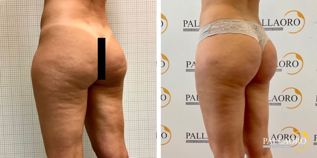 liposuzione-lipofilling-290825-03 liposuzione lipofilling-290825-03