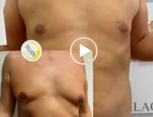Liposuzione pettorali e addome nell’uomo: Video 05