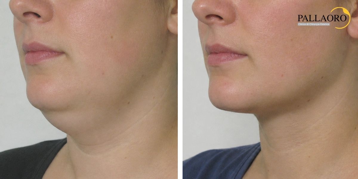 liposuzione viso collo prima dopo (1) liposuzione viso collo prima dopo (1)
