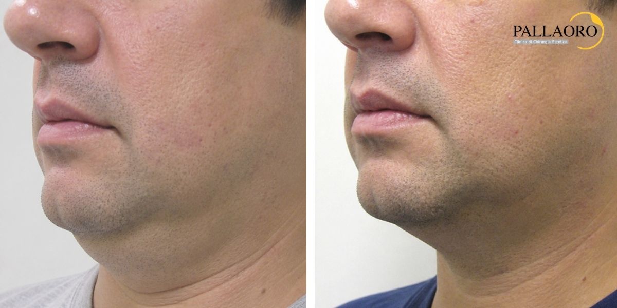 liposuzione viso collo prima dopo (3) liposuzione viso collo prima dopo (3)