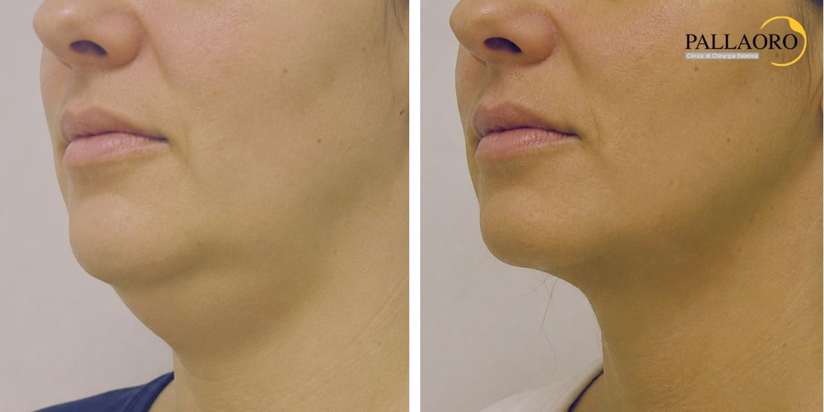 liposuzione viso collo prima dopo (4) liposuzione viso collo prima dopo (4)