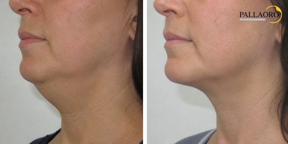 liposuzione viso collo prima dopo (5) liposuzione viso collo prima dopo (5)