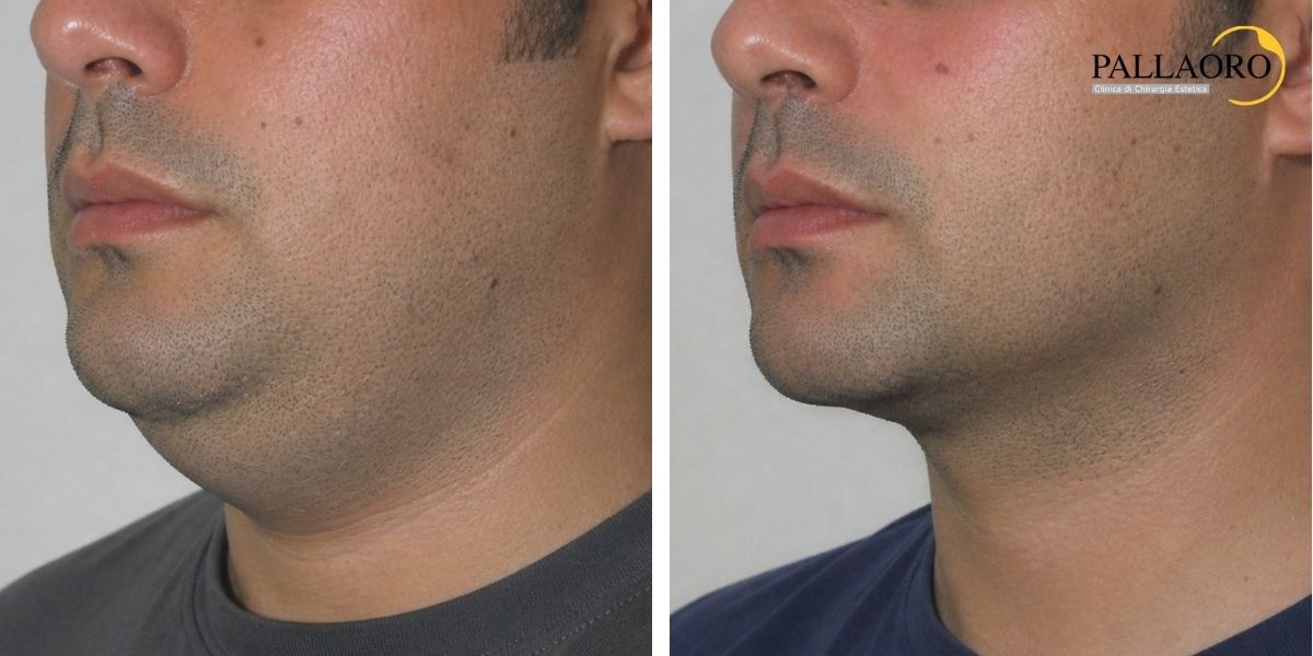 liposuzione viso collo prima dopo (6) liposuzione viso collo uomo prima dopo (1)