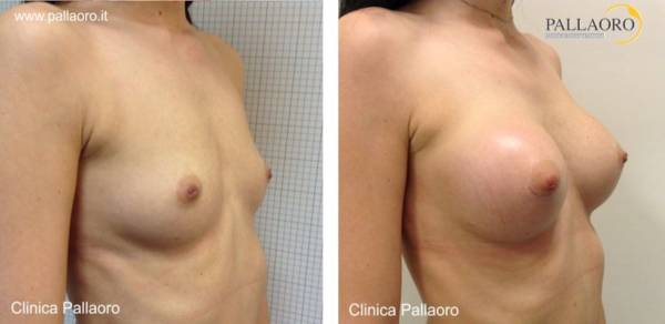 Chirurgia estetica seno Foto di mastoplastica additiva 06