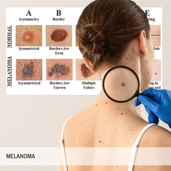 Melanoma: che cos'è, le cause e il ruolo della chirurgia estetica