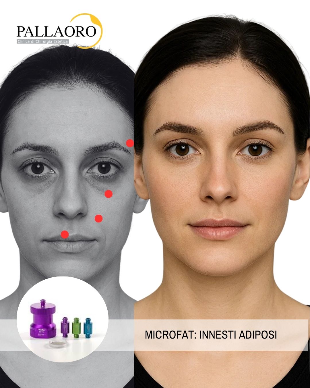 microfat innesti adiposi (2)