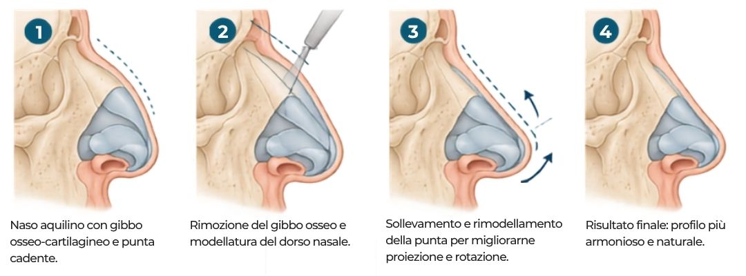 naso aquilino rinoplastica naso aquilino - intervento di rinoplastica