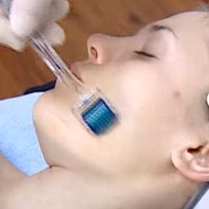 needling 004 needling trattamento