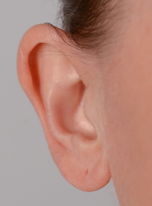 Orecchia a sventola: Assenza o insufficienza piega cartilaginea