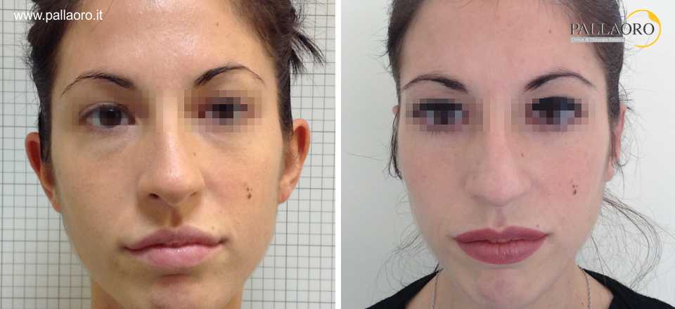 otoplastica 0018 Otoplastica Trento