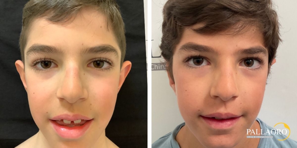 otoplastica prima dopo bambino con orecchie a sventola 1
