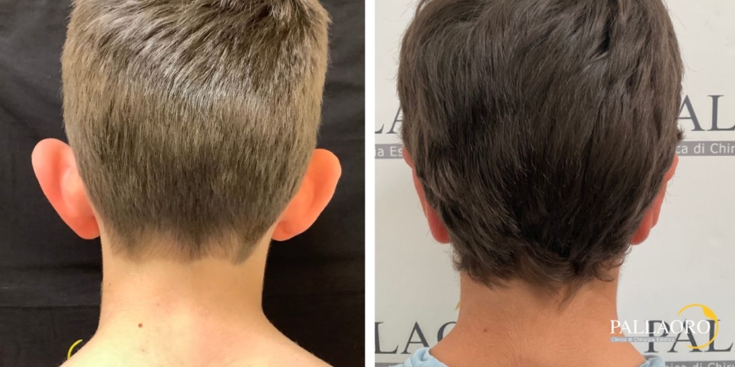 otoplastica prima dopo bambino con orecchie a sventola 2