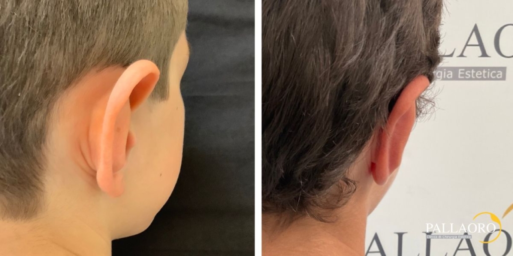 otoplastica prima dopo bambino con orecchie a sventola 3
