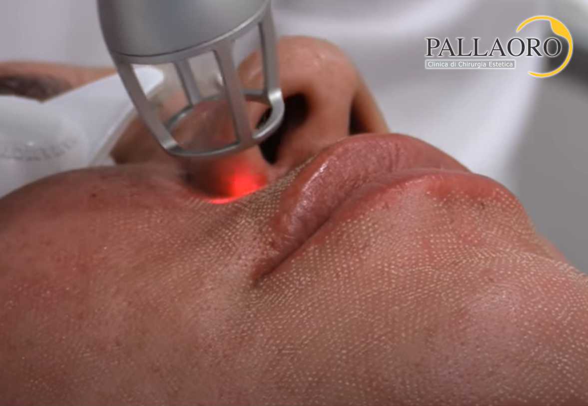 peeling laser frazionato viso e codice a barre