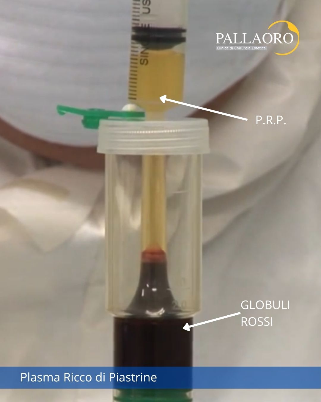PRP (Plasma Ricco di Piastrine): cos'è, come funziona e quando è indicato
