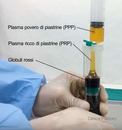 piastrine del PRP