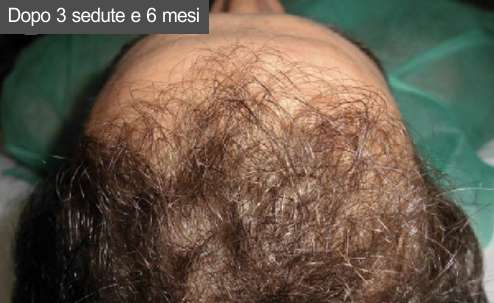 Prp capelli 2 Dopo sei mesi dalla fine delle sedute