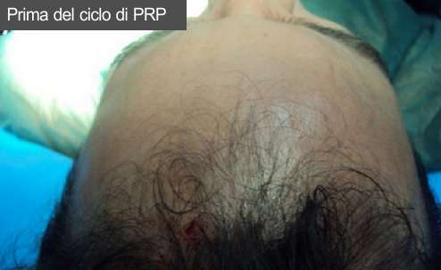 Prp capelli 2 Prima del trattamento