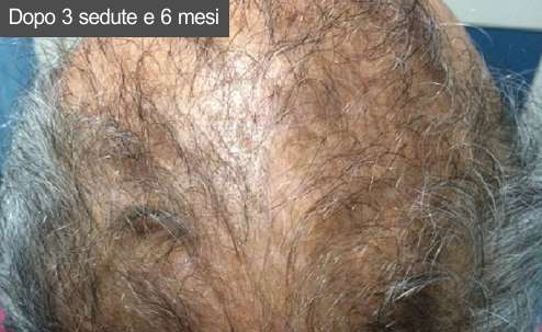 Prp capelli Dopo sei mesi dalla fine delle sedute