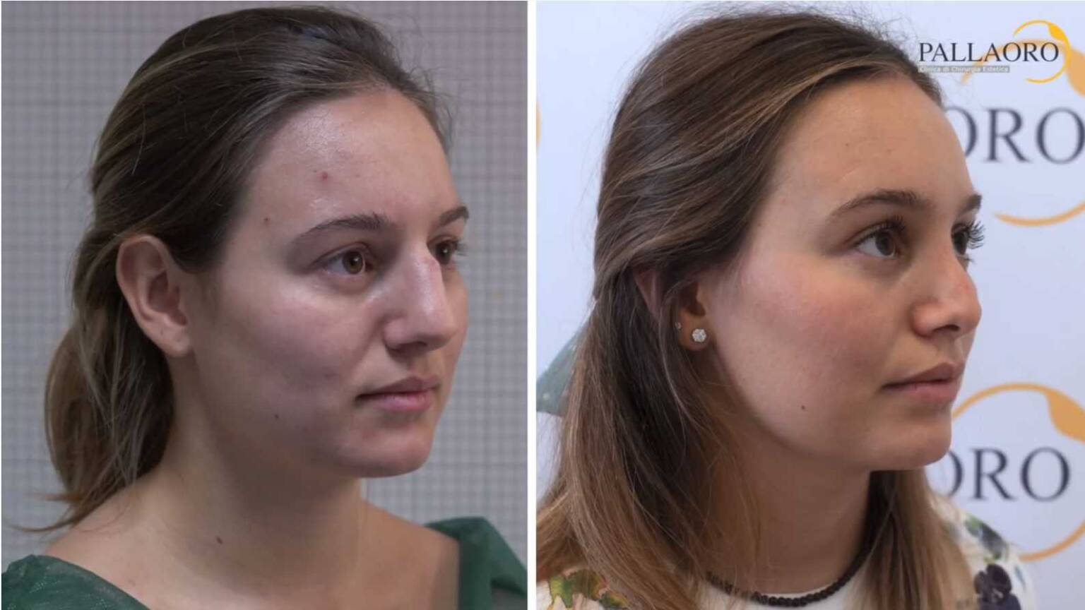 Rinoplastica prima e dopo con correzione del gibbo dorsale