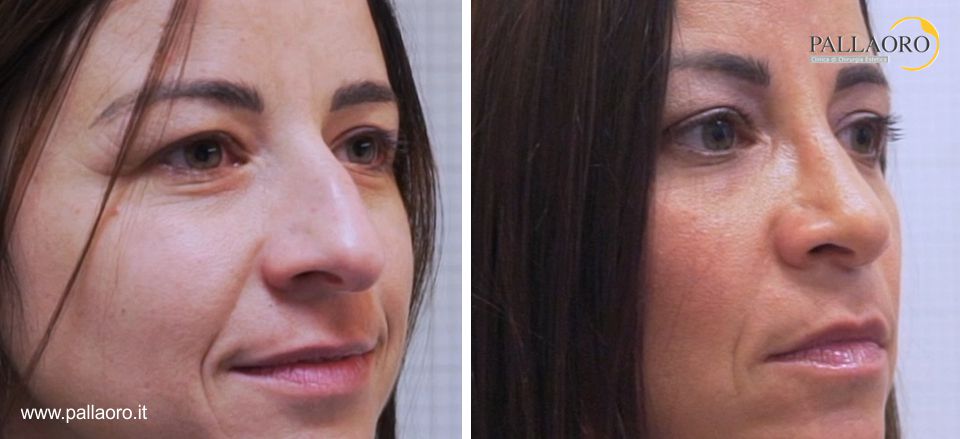 Rinoplastica prima e dopo con affinamento del naso nella vista frontale