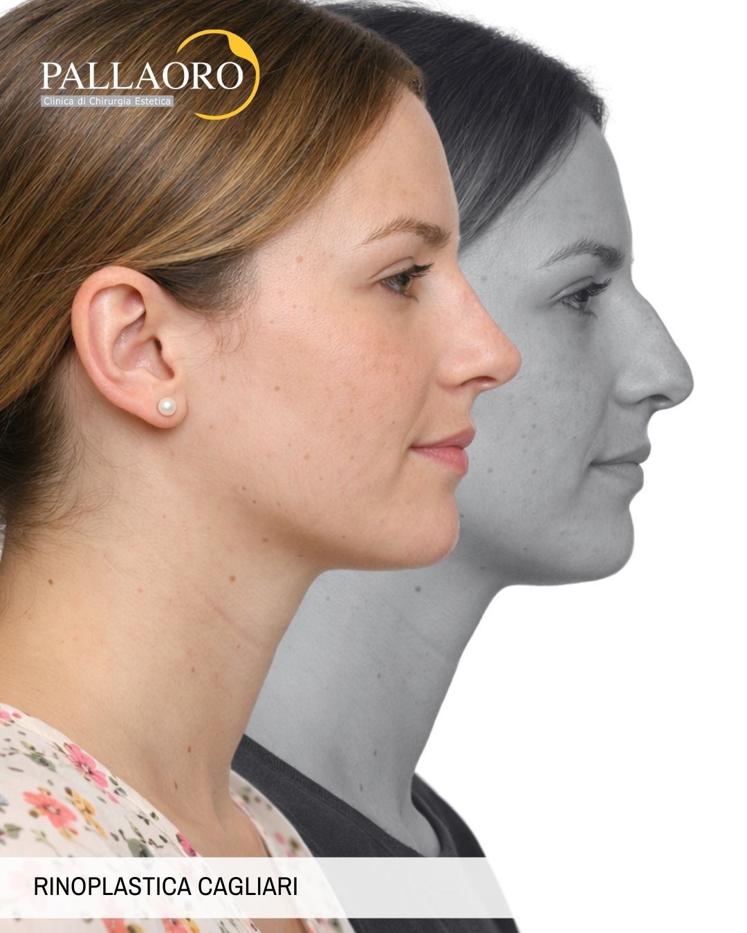 rinoplastica cagliari