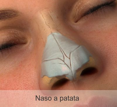 Chirurgia estetica naso a patata