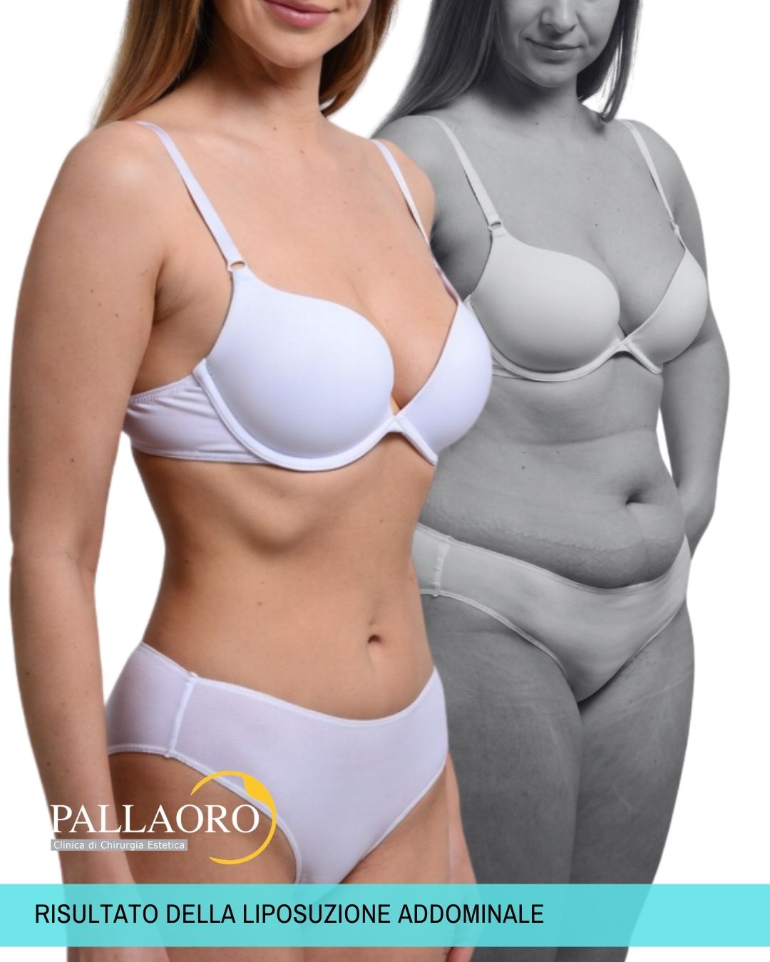 risultato della liposuzione addominale (1) risultato della liposuzione addominale