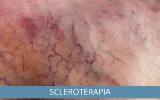 Scleroterapia