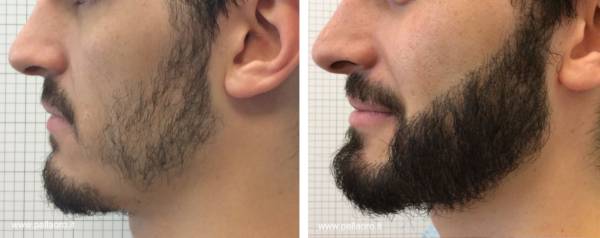 trapianto capelli a barba 01