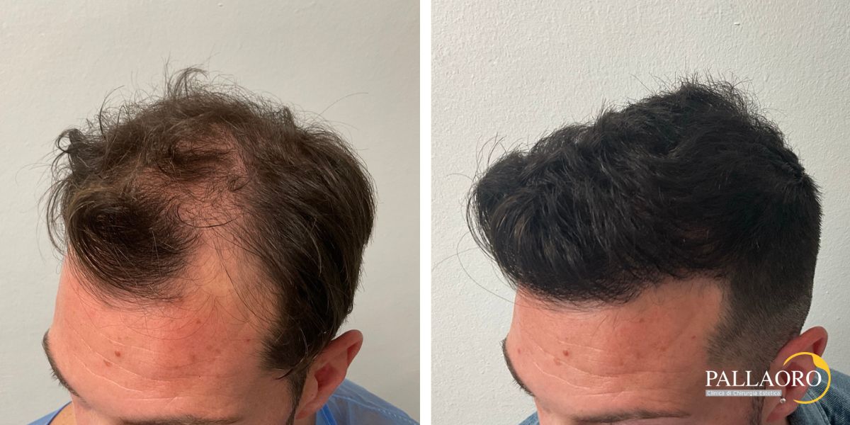 trapianto capelli 250902 (1) trapianto capelli 2501 a