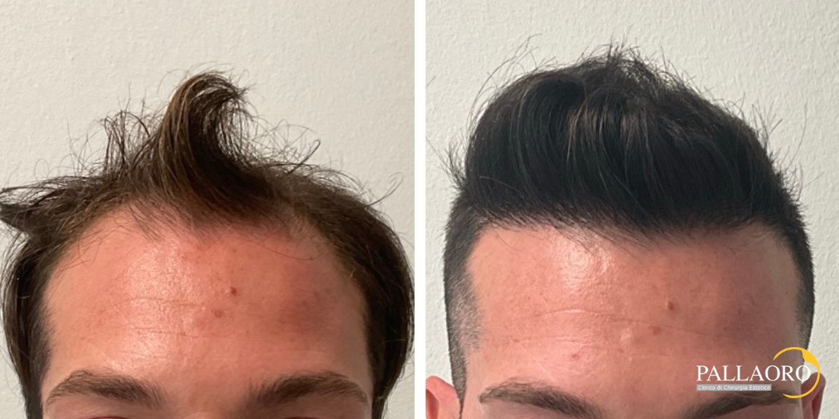 trapianto capelli 250902 (2) trapianto capelli 2501 a