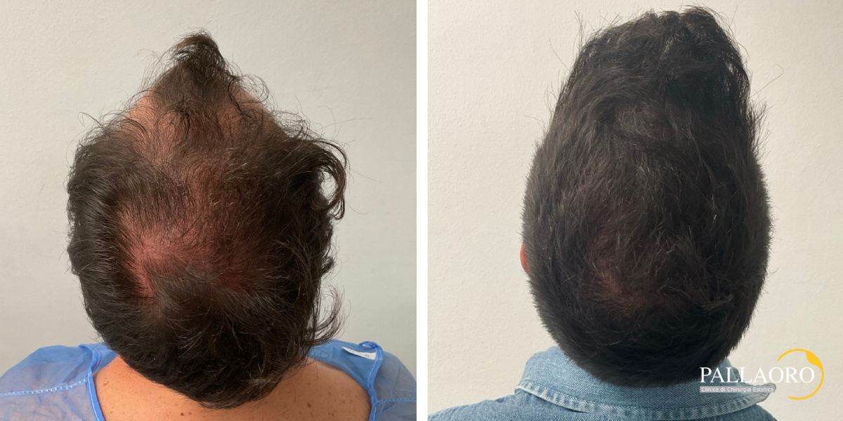 trapianto capelli 250902 (3) trapianto capelli 2501 d