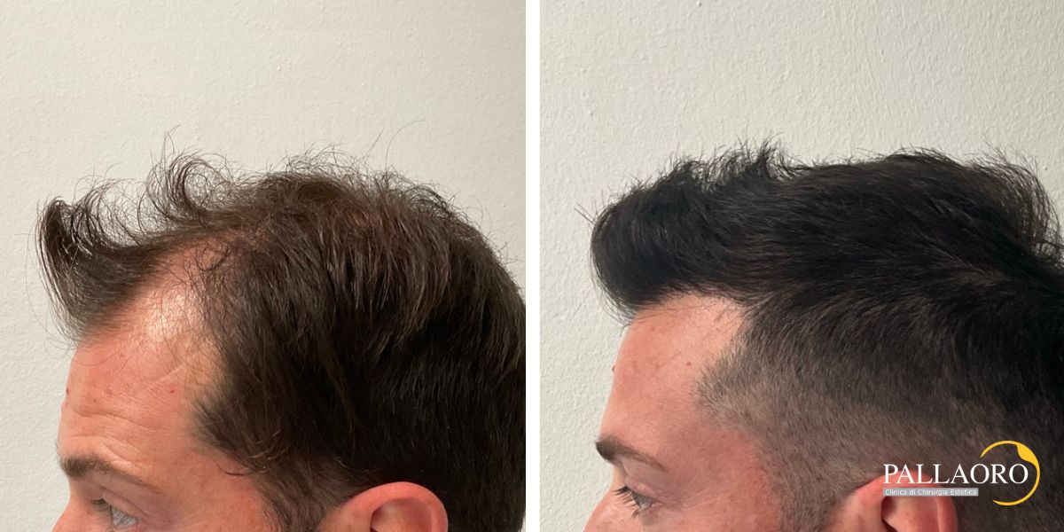 trapianto capelli 250902 (5) trapianto capelli 2501 b