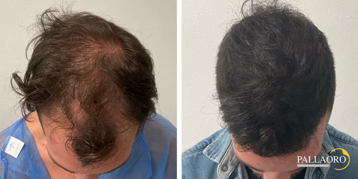 trapianto capelli 250902 (6) trapianto capelli 2501 a
