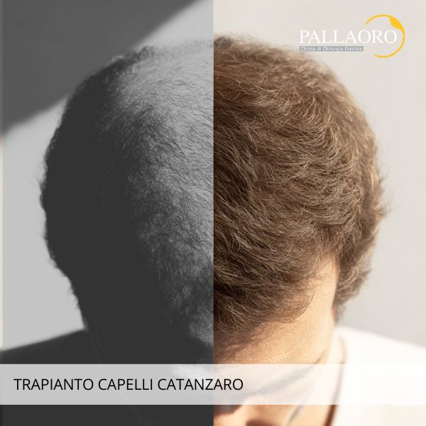 Trapianto capelli Catanzaro