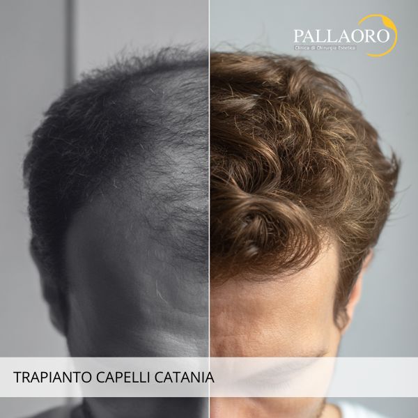 Trapianto Capelli Catania