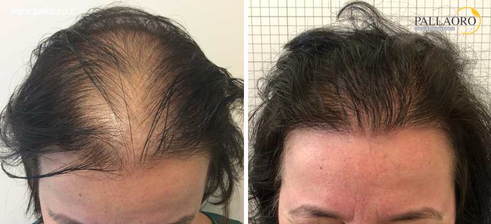 Trapianto capelli donna: Differenza, tecnica, costo | Clinica Pallaoro