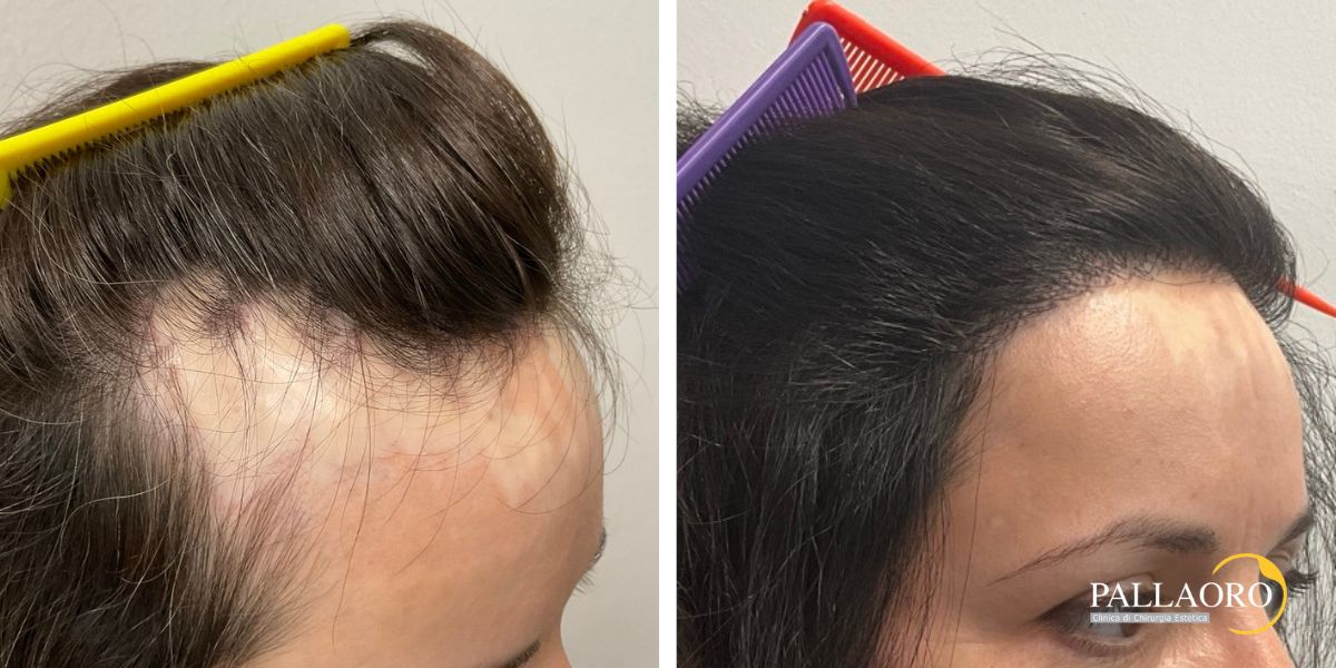 trapianto capelli donna cicatrice ustione (2)