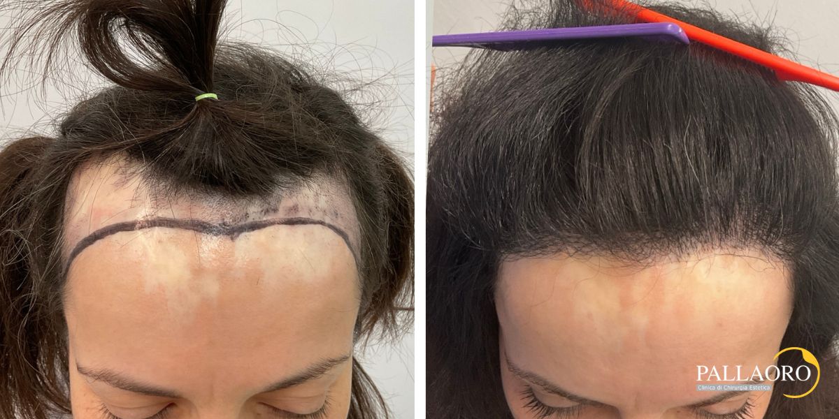 trapianto capelli donna cicatrice ustione (3)