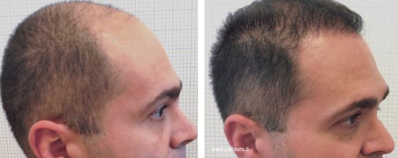 Trapianto capelli costi e prezzi autotrapianto capelli | Clinica Pallaoro