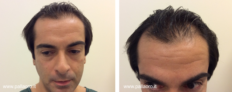 trapianto capelli mario 01