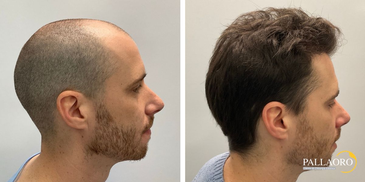 trapianto capelli paziente giovane (1) trapianto capelli paziente giovane per calvizie precoce (1)