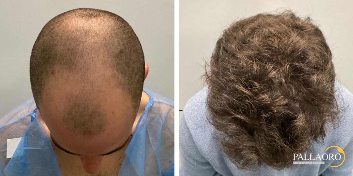 trapianto capelli paziente giovane (3) trapianto capelli paziente giovane per calvizie precoce (3)