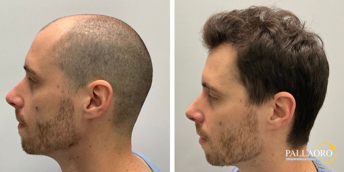 trapianto capelli paziente giovane (4) trapianto capelli paziente giovane per calvizie precoce (4)