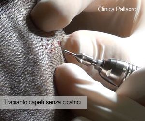 Trapianto capelli con tecnica Trilix Follicolare