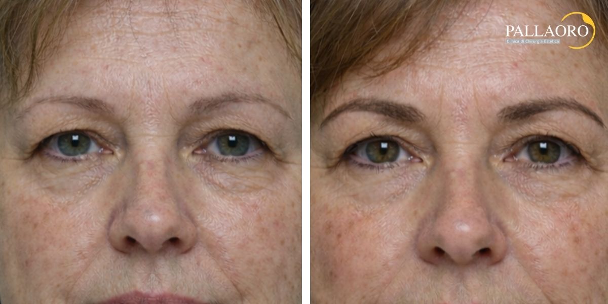 trapianto sopracciglia donna prima dopo 01