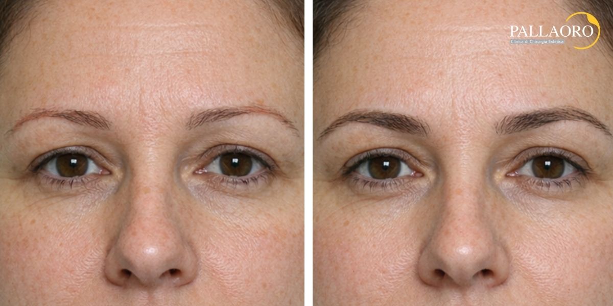 trapianto sopracciglia donna prima dopo 04
