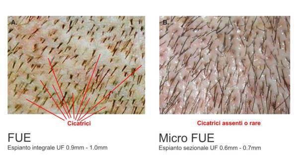 Zona donatrice a confronto tra FUE e Micro FUE