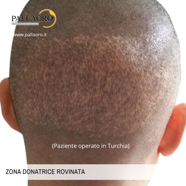 zona donatrice rovinata turchia